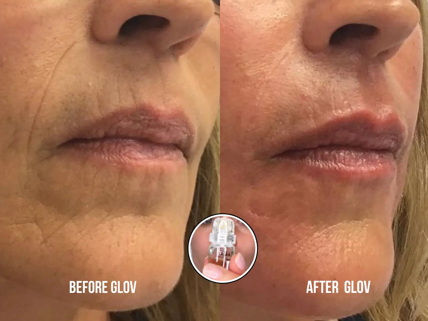 Glov Micro Infusion System